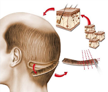 prix chirurgie capillaire Tunisie